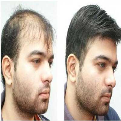 Men-Hair-Patch Men-Hair-Patch