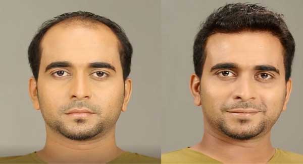 Non-Surgical-Hair Non-Surgical-Hair